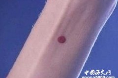 古代女子的守宫砂是真的吗？