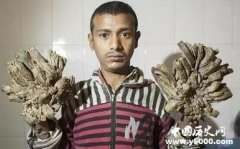 奇人奇事 林天转：全身长壳的“珊瑚人”