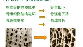 世界骨质疏松日的设立时间发展影响和主题