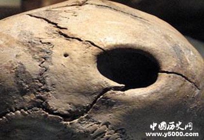 古代人有开颅手术吗 古代人治疗脑科疾病的方法