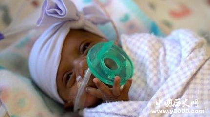 最小存活婴儿出院_世界最小存活婴儿有多重
