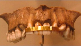 古人什么时候掌握的镶牙技术 滑铁卢牙的来源